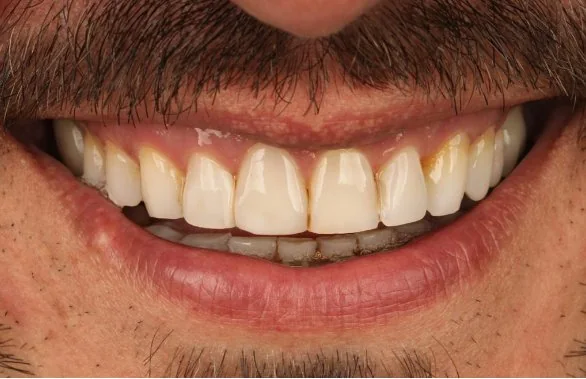 Sorriso do paciente no diagnóstico, com desgaste nas bordas dos dentes