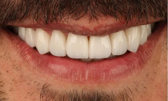 O mesmo sorriso após o tratamento, com dentes alinhados e uniformes