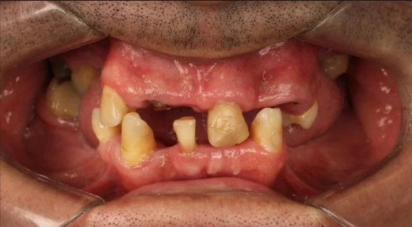Arcada do paciente no diagnóstico, com poucos dentes remanescentes