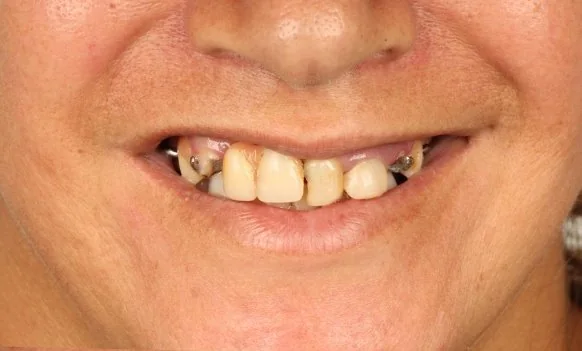Sorriso da paciente no diagnóstico, com ausência de dentes na arcada superior