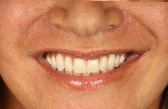 O mesmo sorriso após o tratamento, com a arcada reabilitada