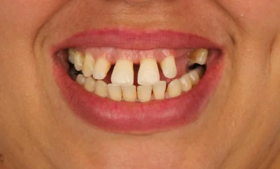 Sorriso da paciente no diagnóstico, com dentes separados e desalinhados