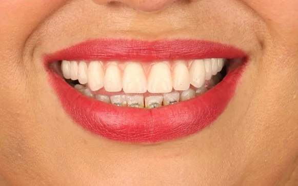 O mesmo sorriso após o tratamento, com dentes alinhados