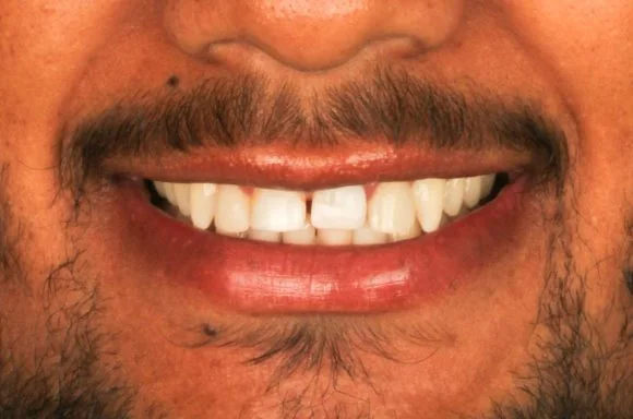 Sorriso do paciente no diagnóstico, com dente da frente lascado