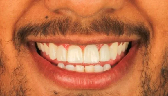 O mesmo sorriso após o tratamento, com os dentes uniformes