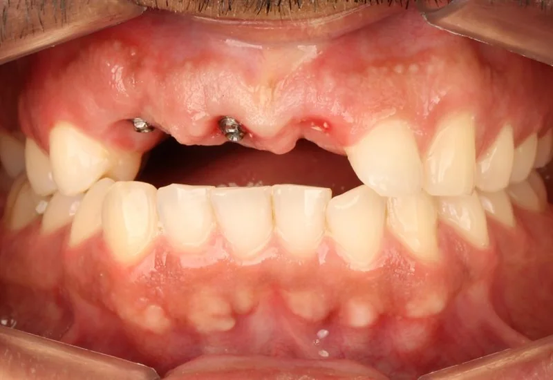 Arcada do paciente no diagnóstico, com ausência dos dentes superiores da frente
