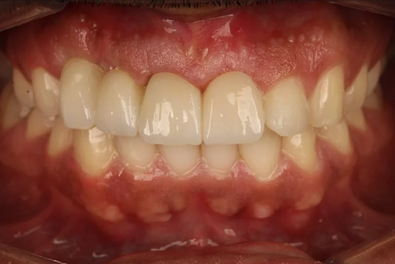 A mesma arcada após o tratamento, com os dentes repostos